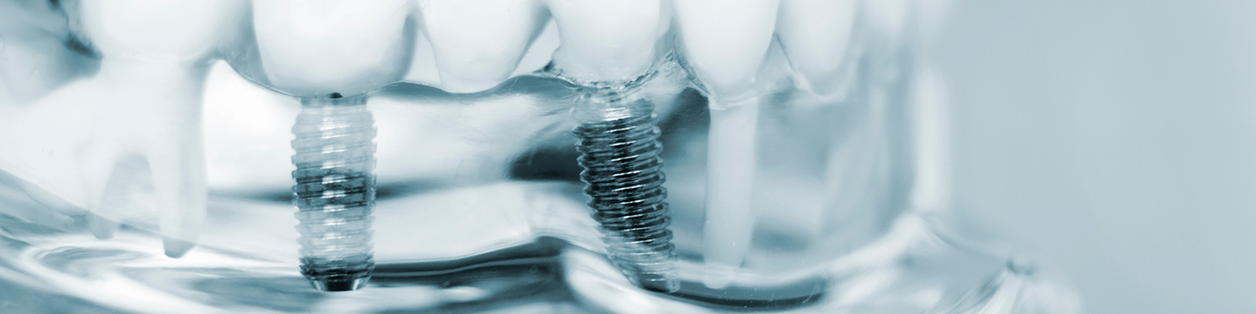 Dental implants in Haverhill in plastic model of mouth