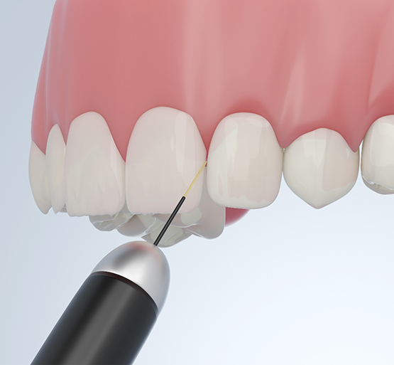 Treating gums with soft tissue laser