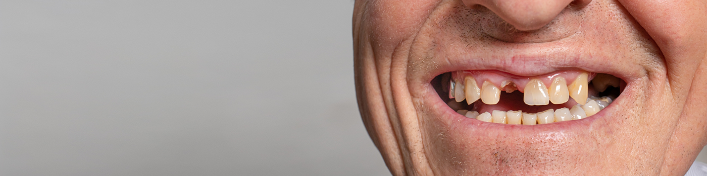 Close up of man with missing tooth in Haverhill