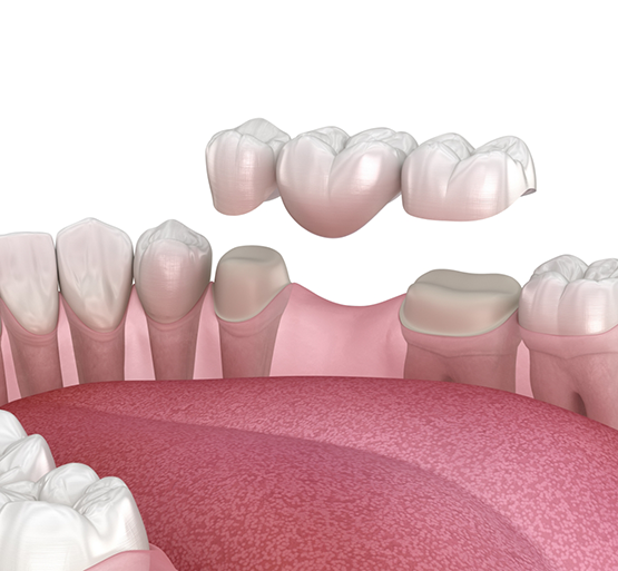 Illustration of dental bridge being attached to prepared teeth