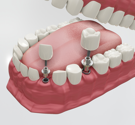 Illustration of dental implants and crowns being placed