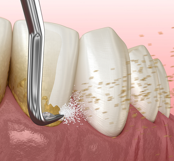 Illustration of scaling and root planing performed on lower teeth