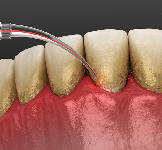 Illustration of laser being used to remove plaque and tartar