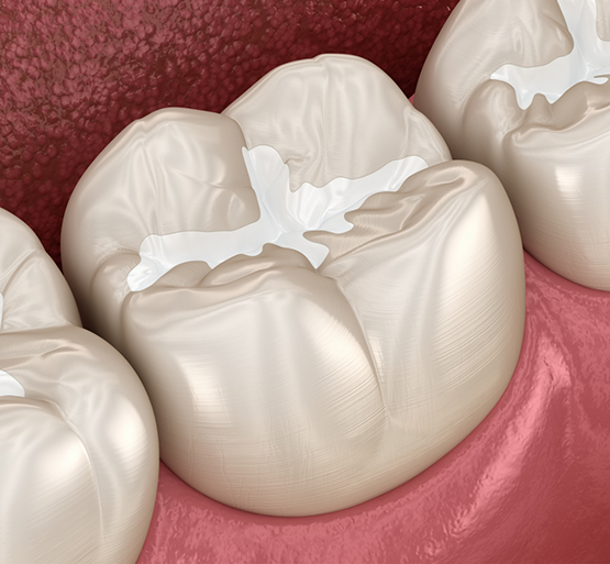 Illustration of teeth with tooth colored fillings