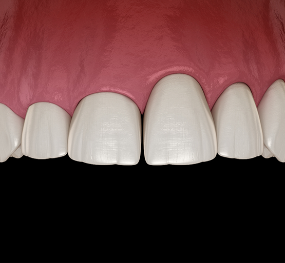 Illustration of one tooth looking longer than the others