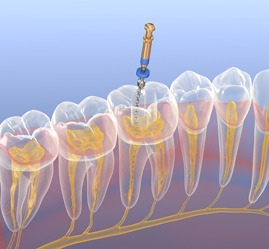 Illustration of root canal treatment performed on tooth in lower arch