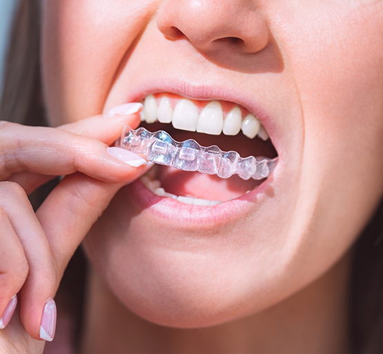 Woman placing aligners over upper teeth