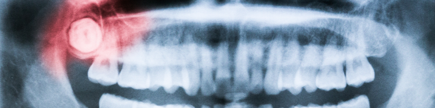 X-ray showing impacted wisdom tooth
