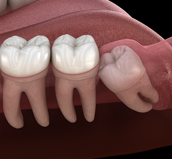 Illustration of impacted wisdom tooth